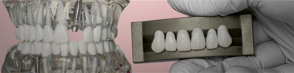 Model showing types of dental implants at Manhattan Arch Implant Center